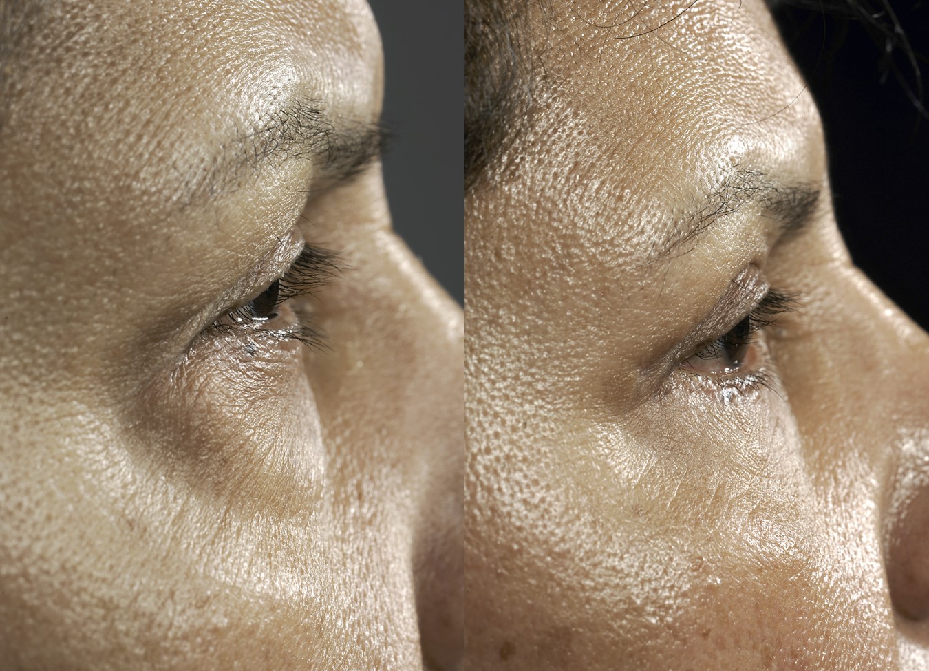 Before & 2 months after upper and lower blepharoplasty (eye lift)