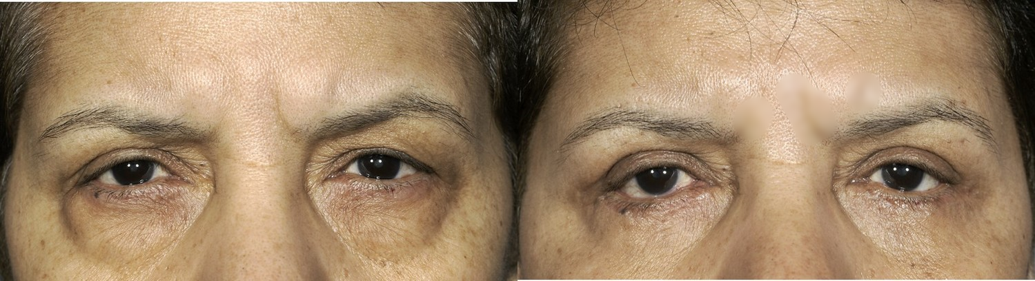 Before & 2 months after upper and lower blepharoplasty (eye lift)