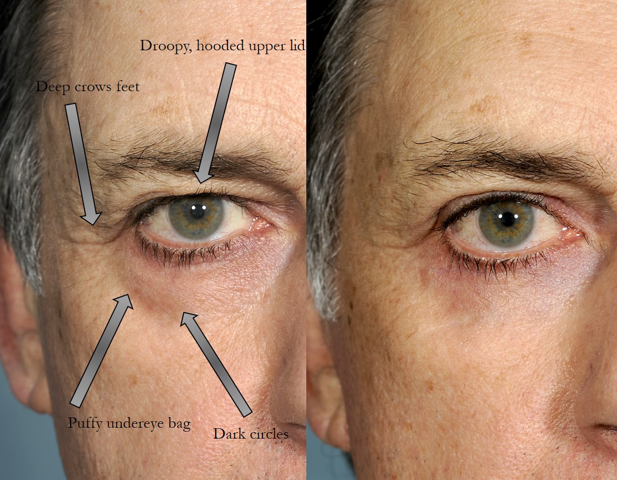 Under Eye Bag Removal Surgery - Rajan Uppal - Exceptional Care