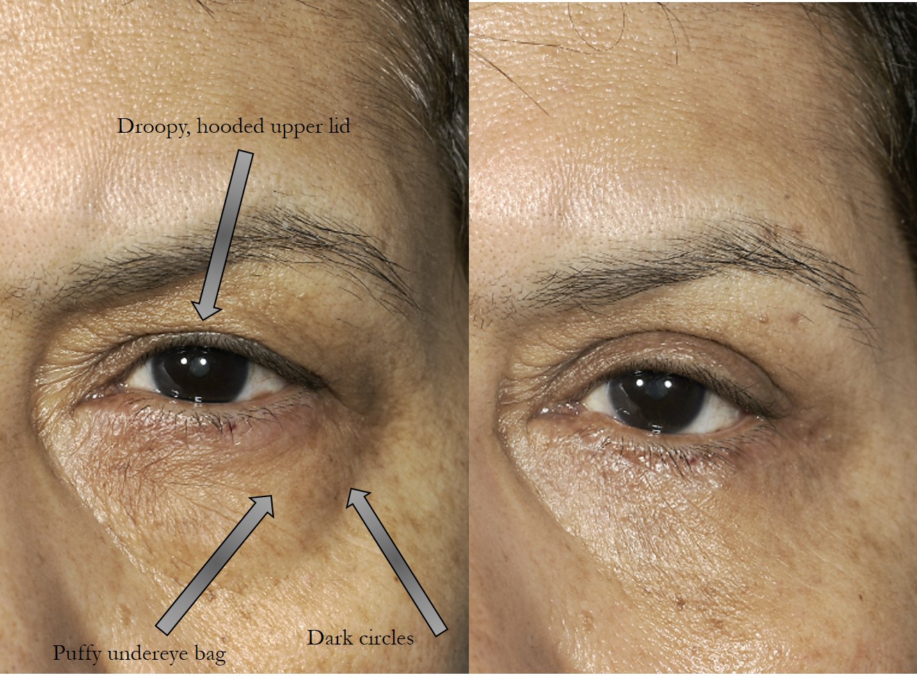 Before & 2 months after upper and lower blepharoplasty (eye lift)