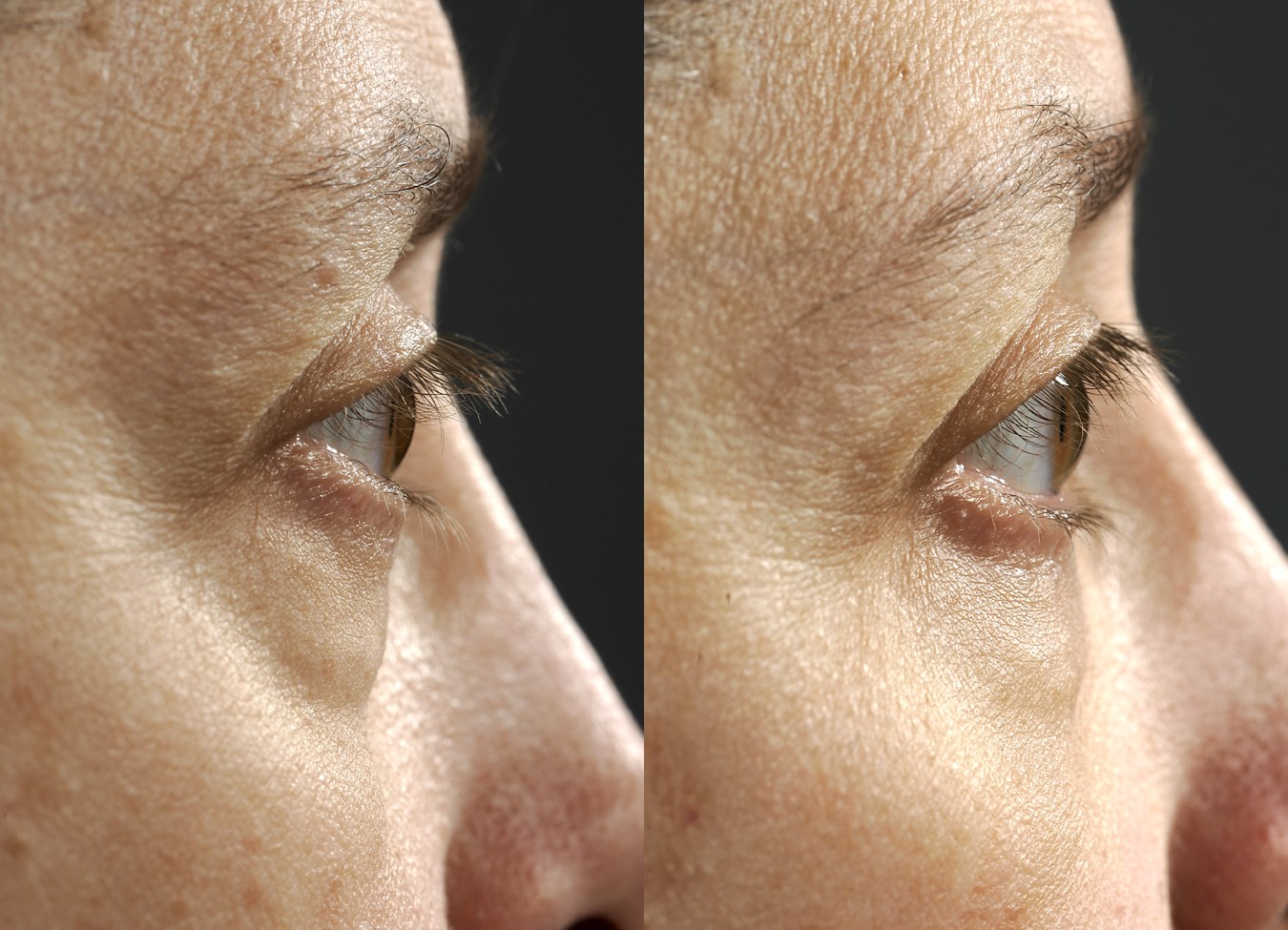 Before & 5 months after transconjunctival lower blepharoplasty (lower eye lift with hidden incisions)