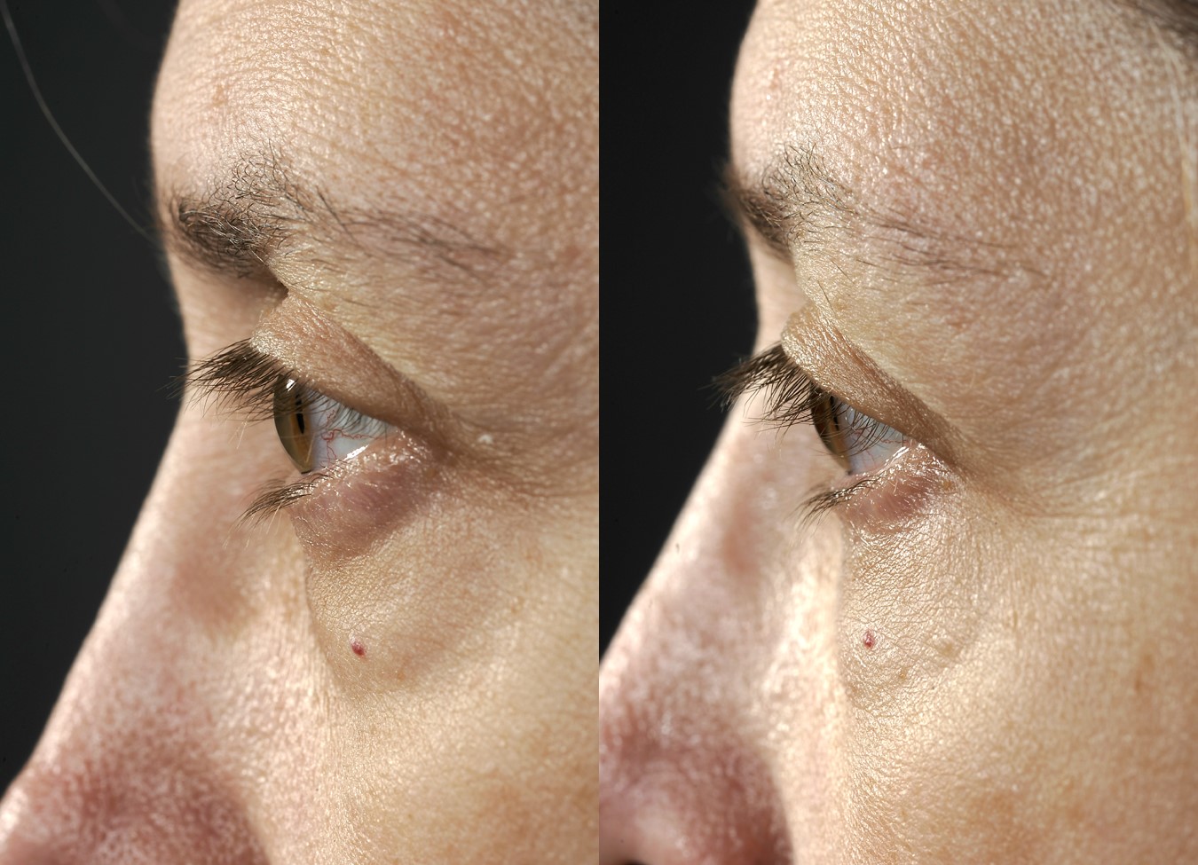 Before & 5 months after transconjunctival lower blepharoplasty (lower eye lift with hidden incisions)