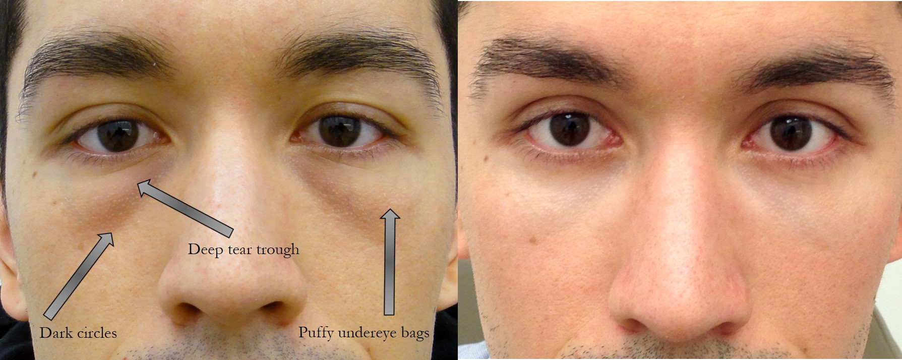 Before & 6 months after lower lid blepharoplasty (eye lift) with hidden incisions