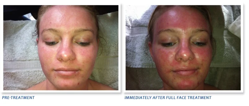 dermapen facial near me