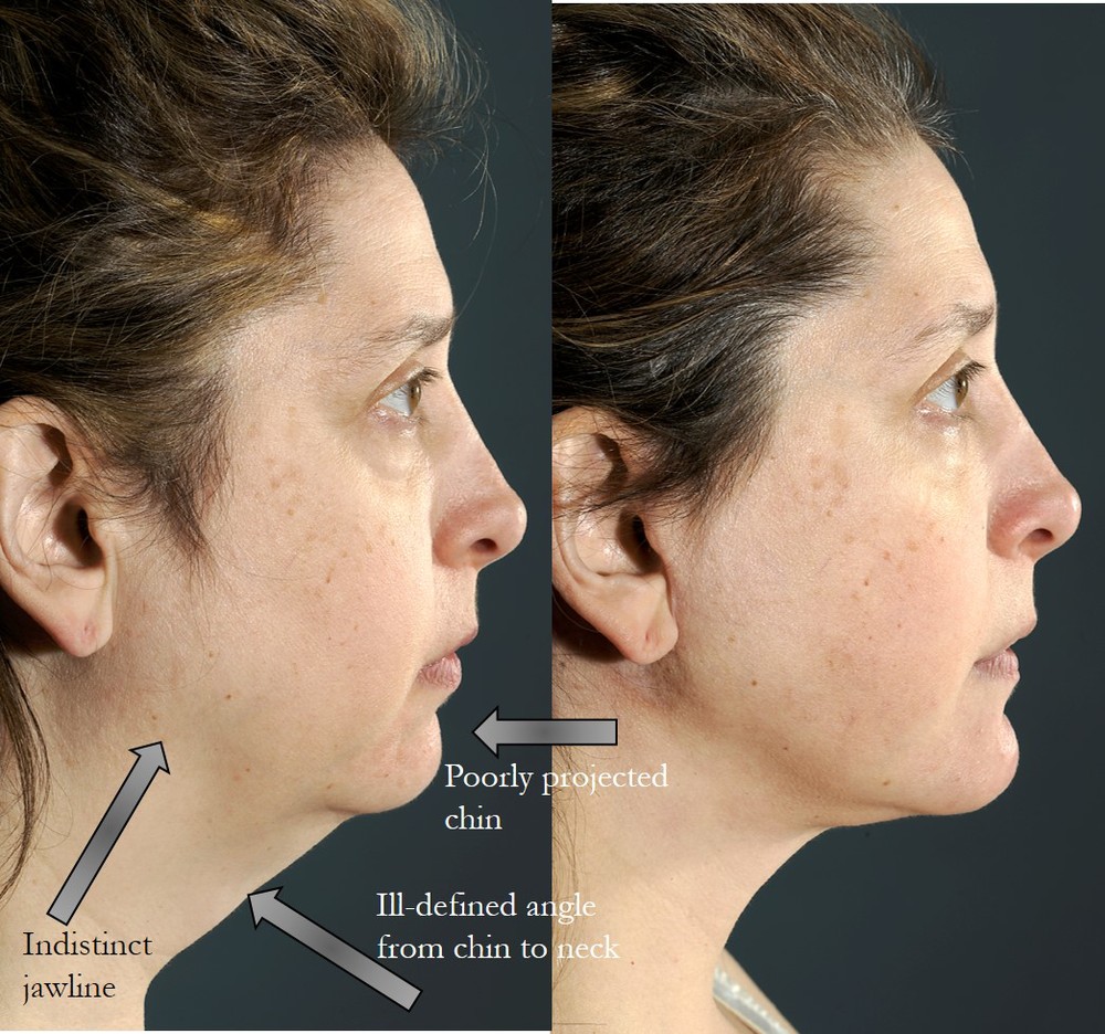 Chin Implants - Parfitt Facial Plastic Surgery Center