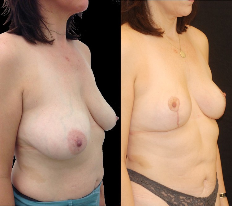 Actual patient of Dr. Devgan, before and 8 weeks after breast lift (mastopexy). Scars are immature and will fade to nearly invisible by 1 year.