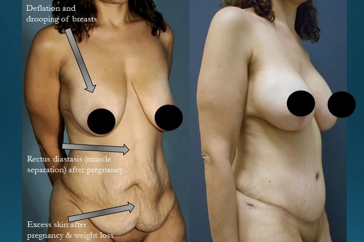 Actual patient of Dr. Devgan, before and after abdominoplasty and breast lift with implants.
