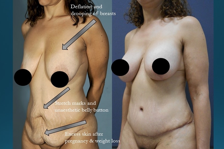 Actual patient of Dr. Devgan, before and after abdominoplasty and breast lift with implants.
