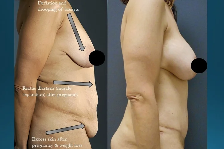 Actual patient of Dr. Devgan, before and after abdominoplasty and breast lift with implants.