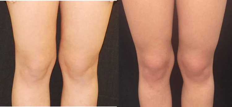 Actual patient of Dr. Devgan, before and after knee liposuction.
