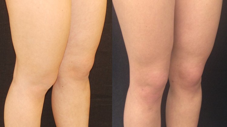 Actual patient of Dr. Devgan, before and after knee liposuction.