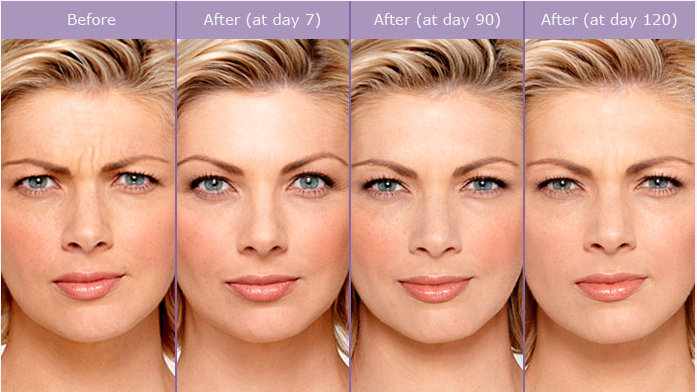 Botox NYC | Fillers NYC | Juvederm Restylane NYC — Lara Devgan, MD, FACS