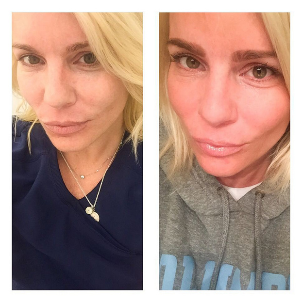 Self-portrait photographs submitted by patient, via Instagram, before & after Dermapen Microneedling, 7/29/15