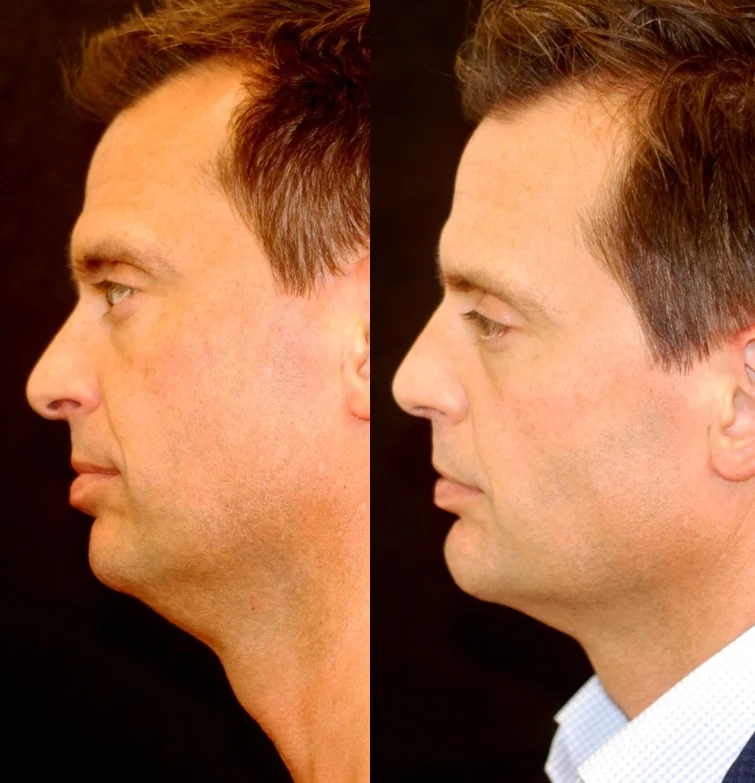 Actual patient of Dr. Devgan, before and after chin augmentation, submental (neck liposuction), and rhinoplasty.