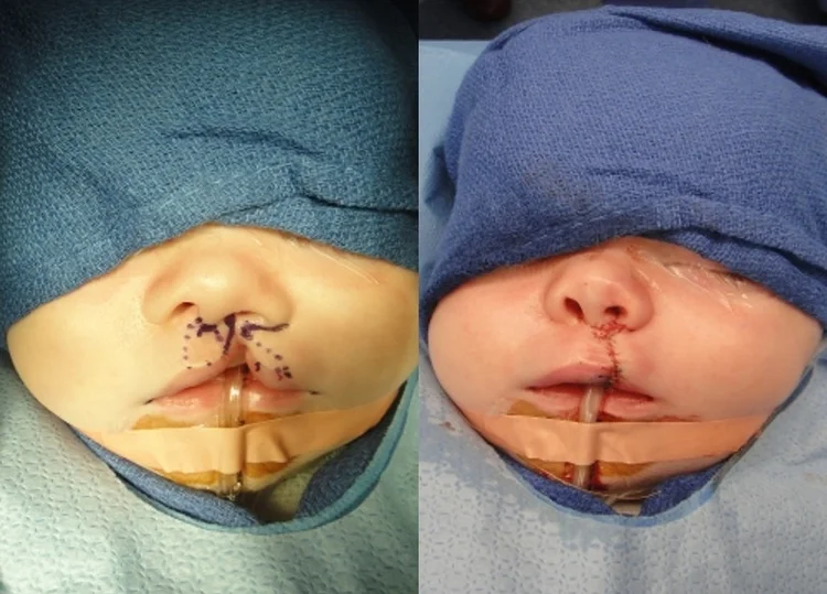 Actual patient of Dr. Devgan, before and after cleft lip repair.
