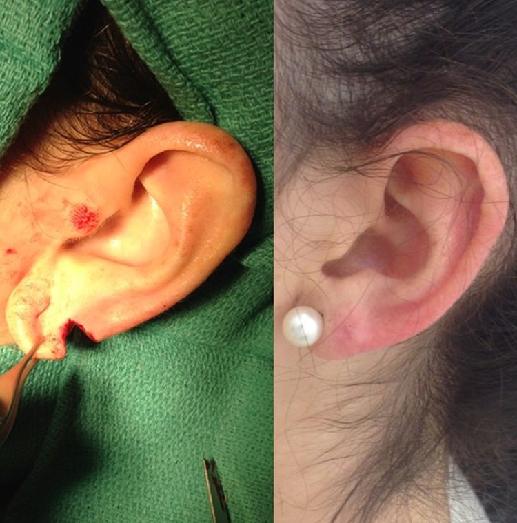 Actual patient of Dr. Devgan, before and after repair of torn earlobe.