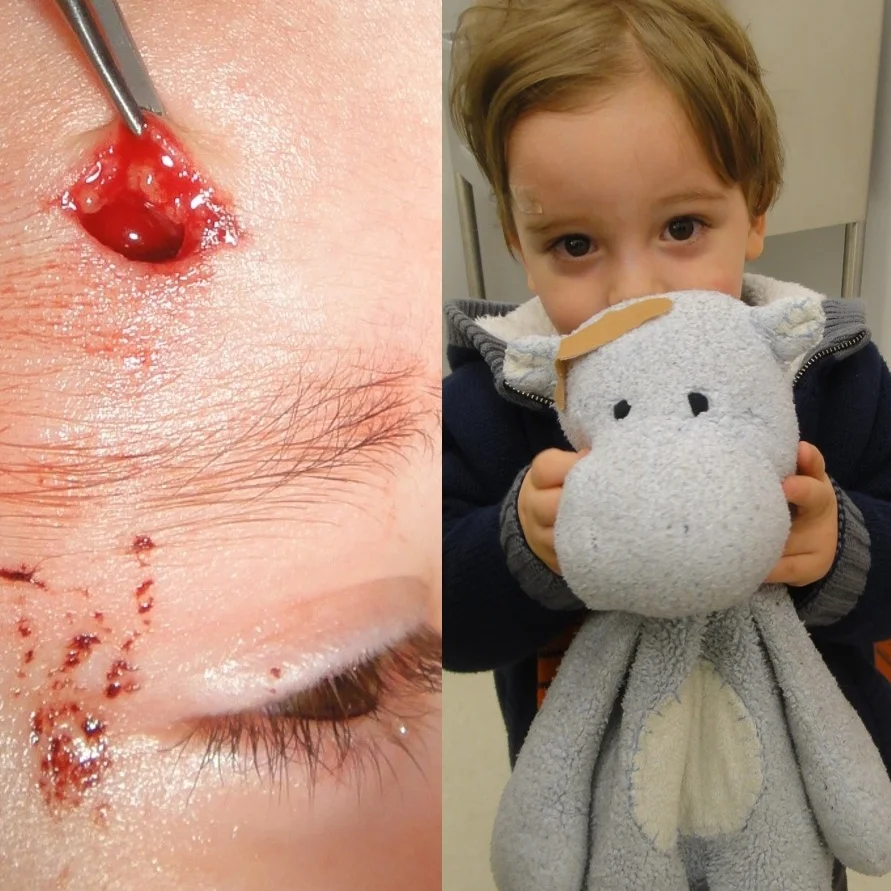 "It wasn't so bad," 2 year old facial laceration patient