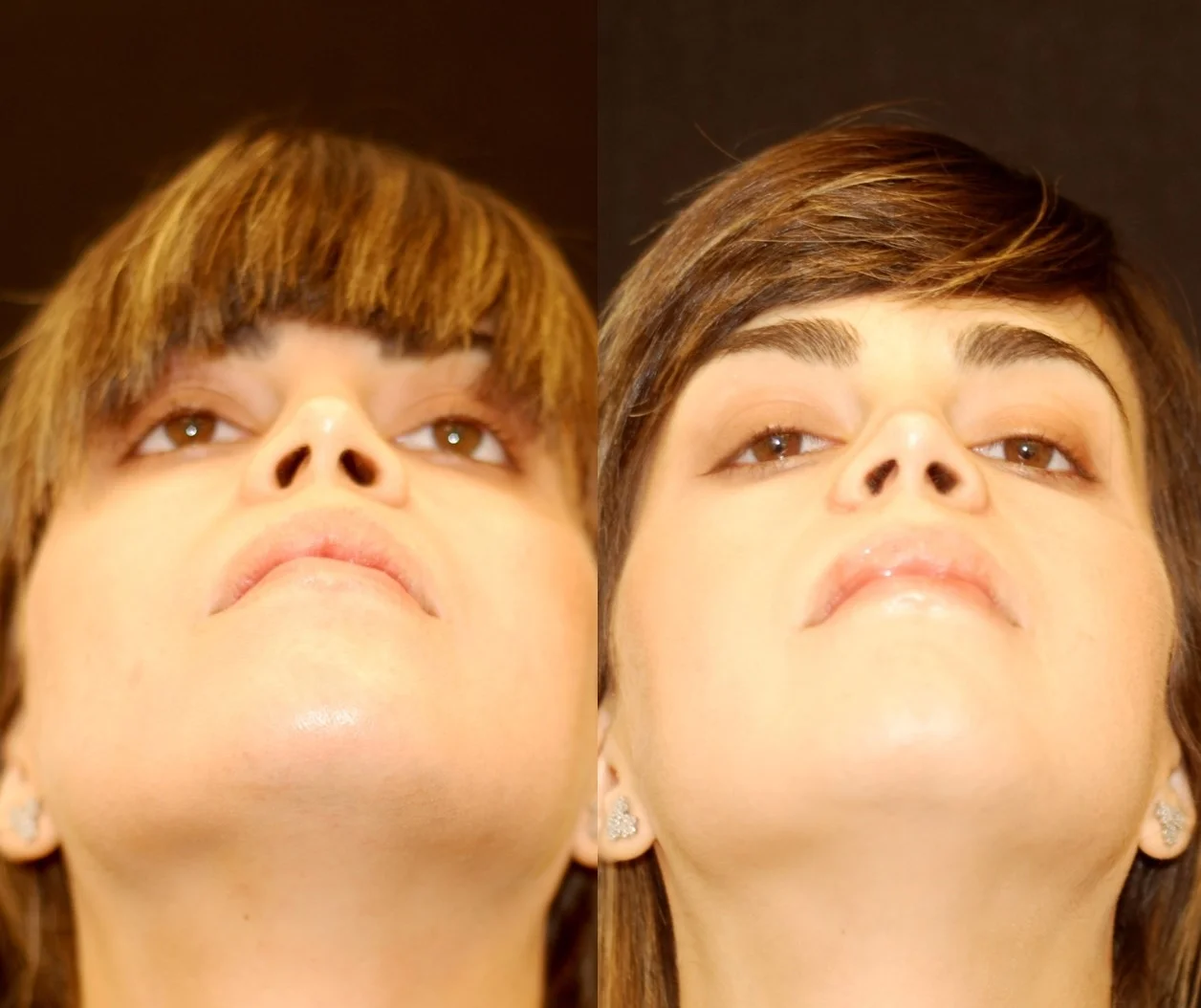 Actual patient of Dr. Devgan, before and 3 weeks after alar base reduction rhinoplasty