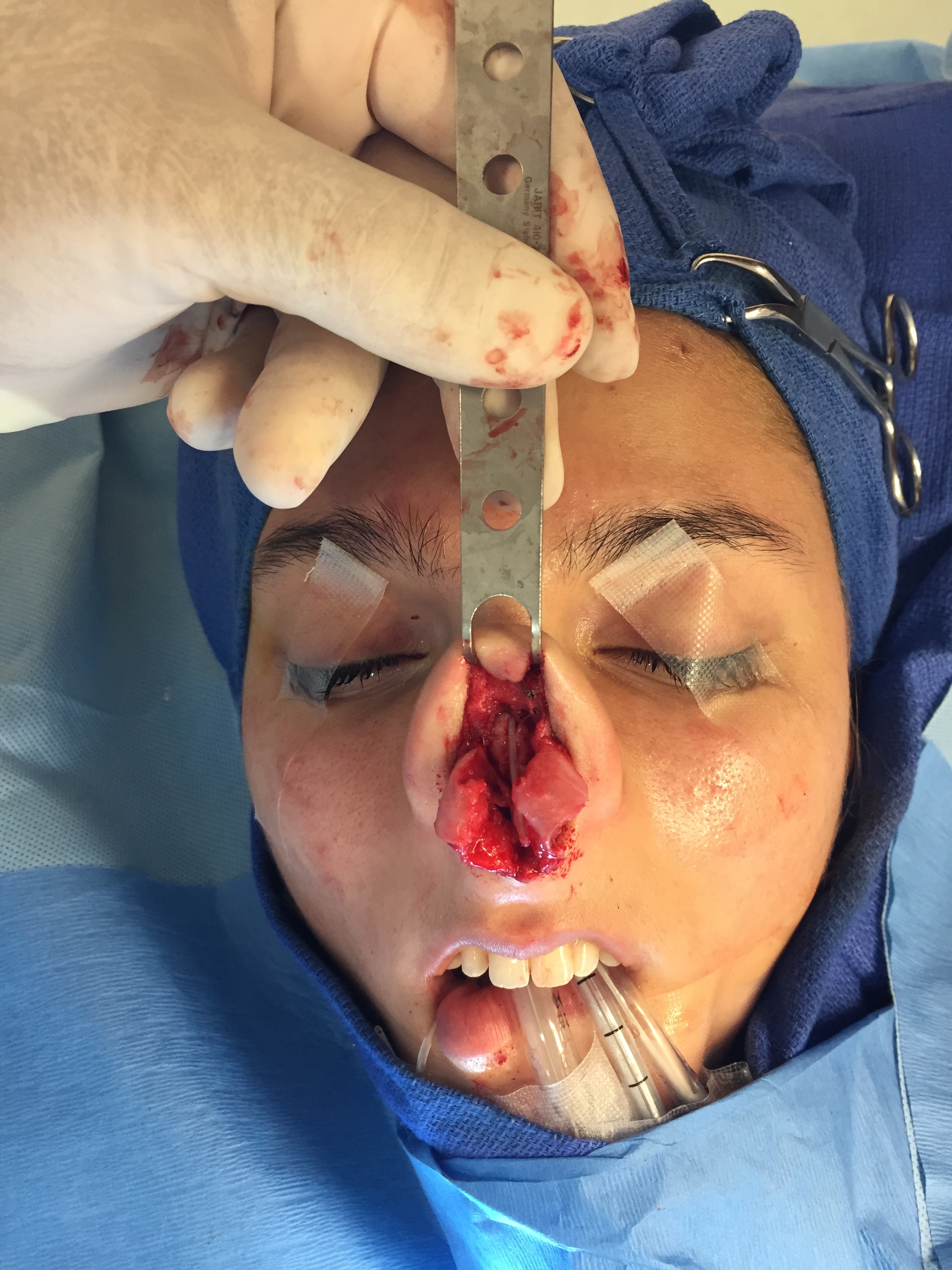 Intraoperative view of nasal anatomy during a complex revision rhinoplasty operation.