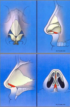 Gunter diagram for analyzing the components of the nose, for rhinoplasty and septoplasty surgery.