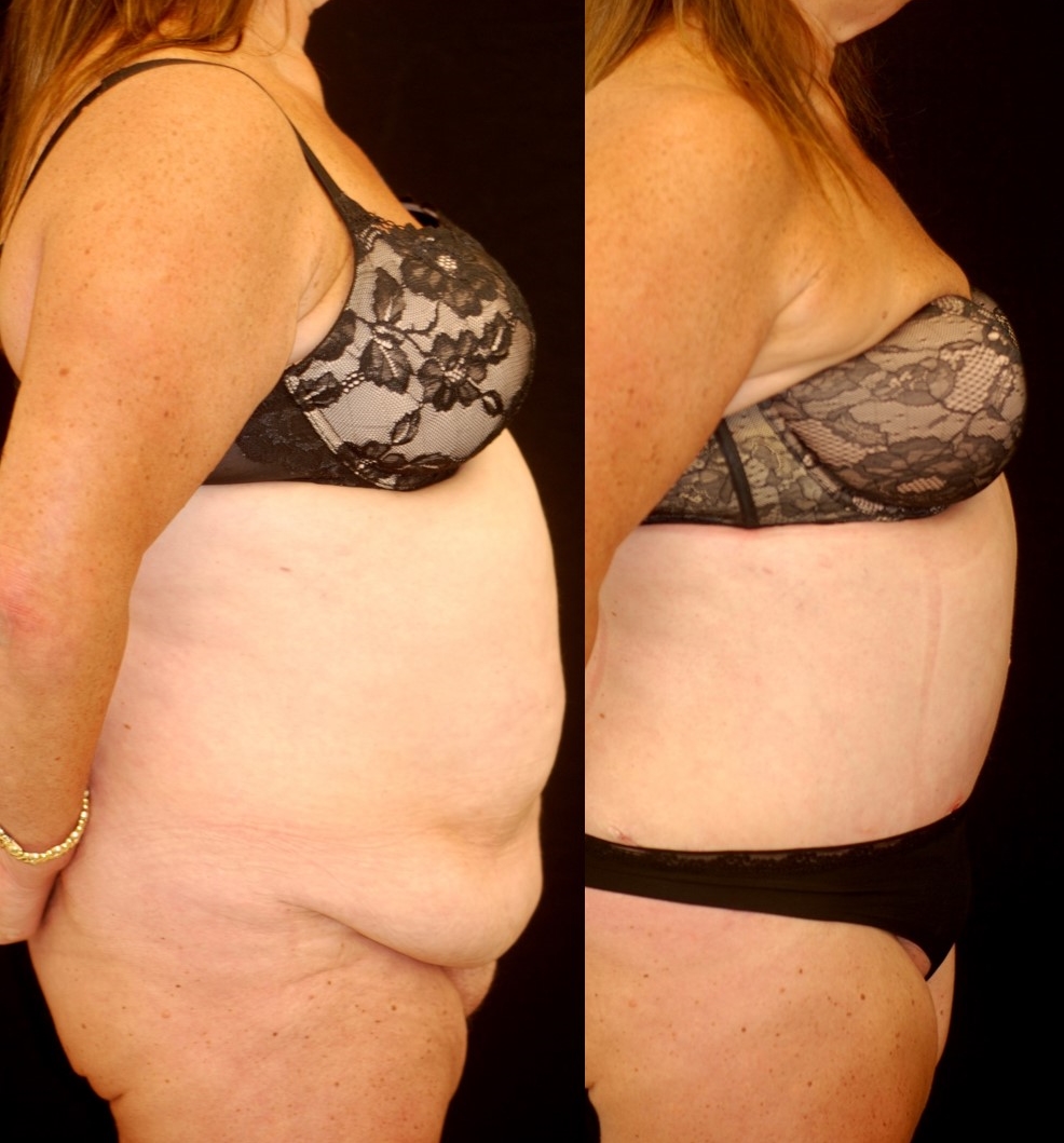 Actual patient of Dr. Devgan, before and 3 weeks after abdominoplasty (tummy tuck) and liposuction, following massive weight loss.
