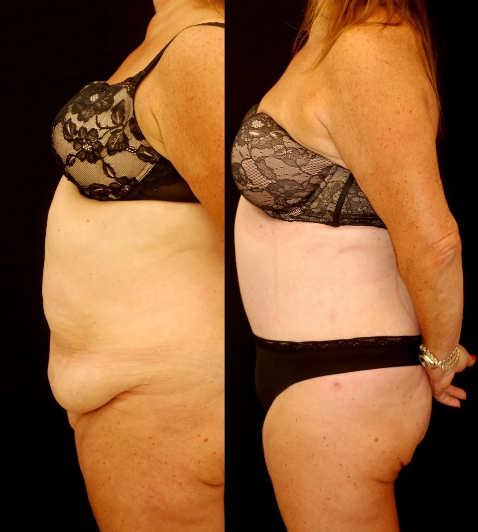 Actual patient of Dr. Devgan, before and 3 weeks after abdominoplasty (tummy tuck) and liposuction, following massive weight loss.