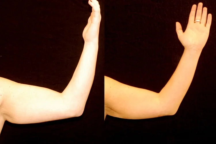 Actual patient of Dr. Devgan, before and after arm liposuction.