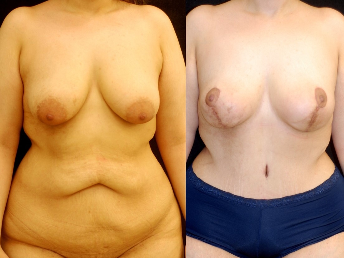 Actual patient of Dr. Devgan, before and 4 weeks after breast lift (mastopexy) and abdominoplasty (tummy tuck). Scars are immature and will fade to nearly invisible by 1 year.