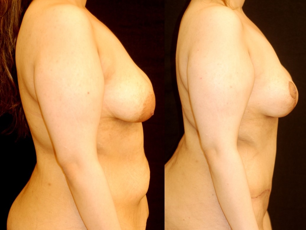 Actual patient of Dr. Devgan, before and 4 weeks after breast lift (mastopexy) and abdominoplasty (tummy tuck). Scars are immature and will fade to nearly invisible by 1 year.