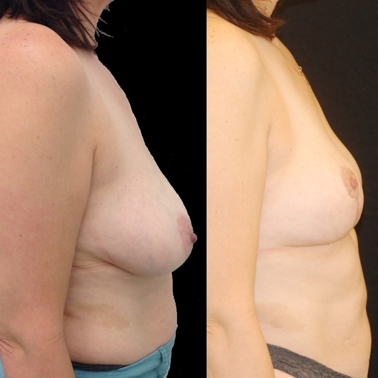 Actual patient of Dr. Devgan, before and 8 weeks after breast lift (mastopexy). Scars are immature and will fade to nearly invisible by 1 year.