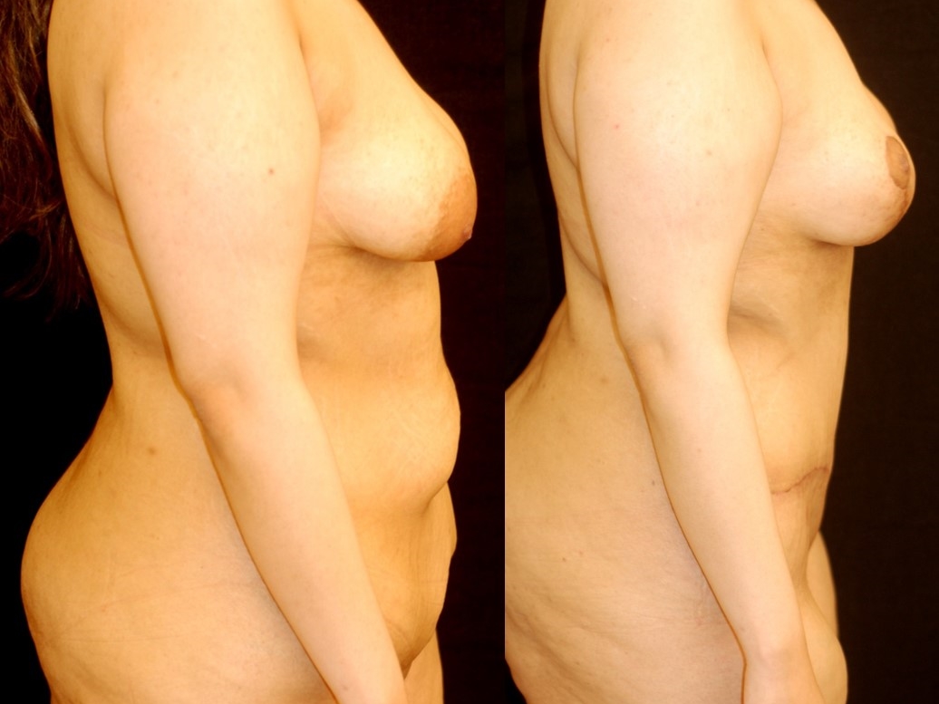 Actual patient of Dr. Devgan, before and after abdominoplasty and mastopexy (breast lift) .