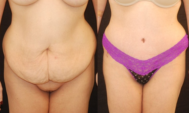 Actual patient of Dr. Devgan, before and after abdominoplasty.