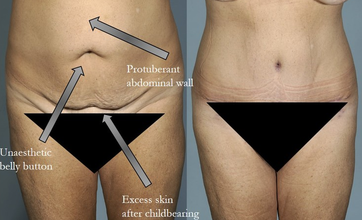 Tummy Tuck NYC  Liposuction NYC — Lara Devgan, MD, MPH, FACS