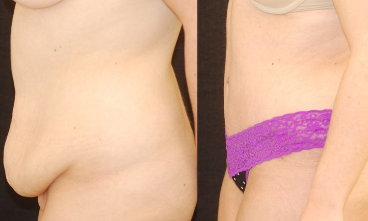 Actual patient of Dr. Devgan, before and after abdominoplasty.