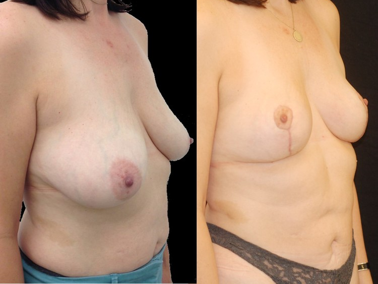 Actual patient of Dr. Devgan, before and after abdominal liposuction and breast lift.