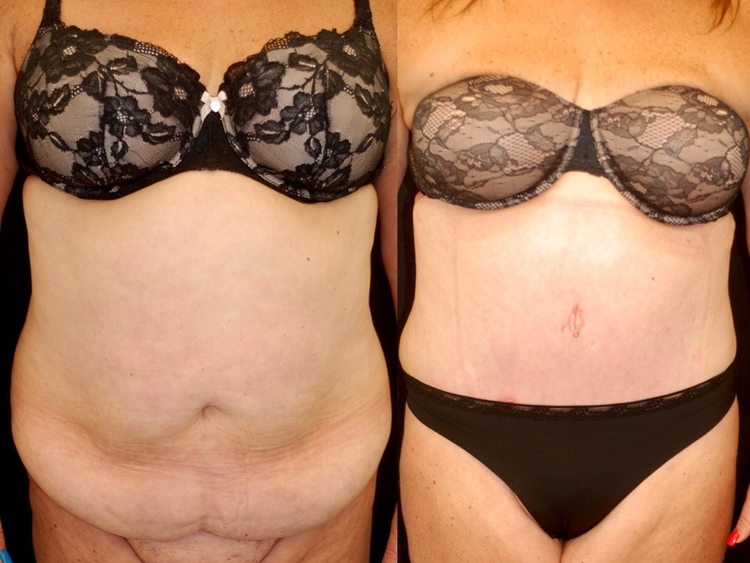 Actual patient of Dr. Devgan, before and after abdominoplasty and liposuction.