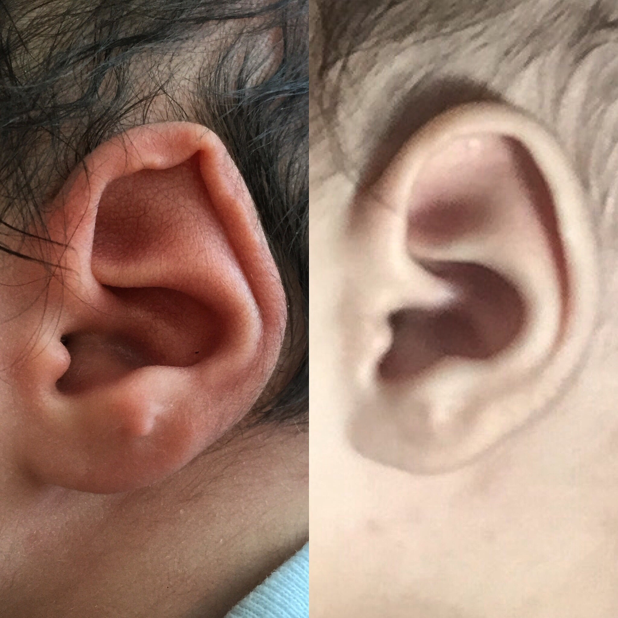 Actual patient of Dr. Devgan, before and after ear molding with Ear Wells.