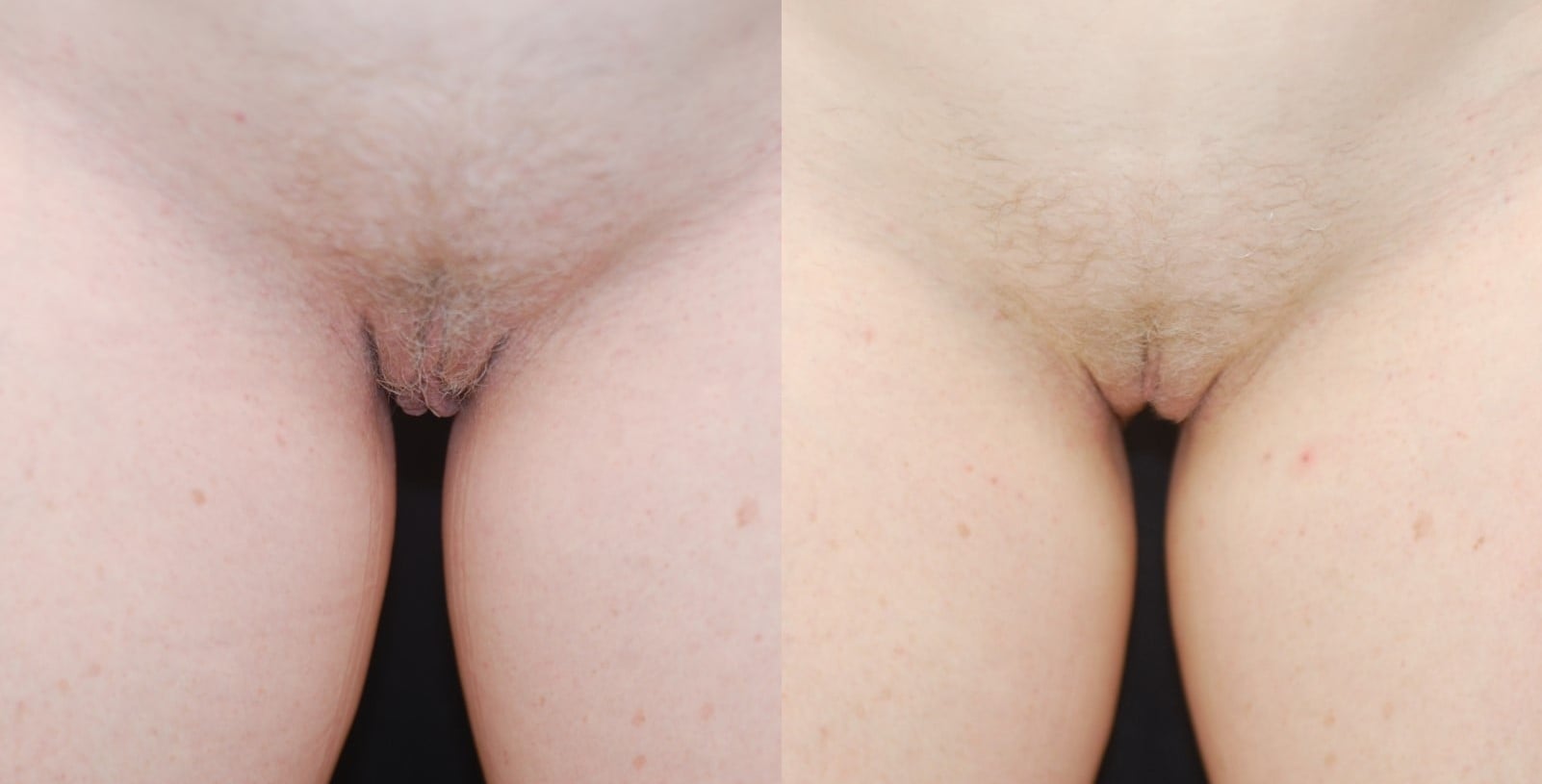 Actual patient of Dr. Devgan, before and 3 months after labiaplasty. This is a middle-aged woman with labia minora excess and perineal excess, corrected with a combination of modified wedge technique and direct excision of perineal tissue.