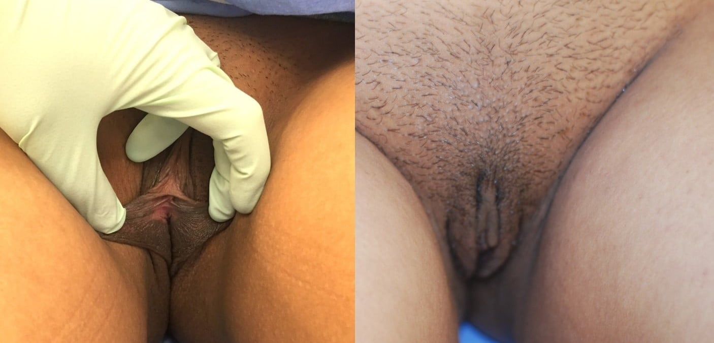 Actual patient of Dr. Devgan, before and 1 week after labiaplasty. This is a young woman with labia minor excess and mild clitoral hood excess, corrected with a modified wedge technique and clitoral hood reduction. This surgery was done under local anesthesia only.