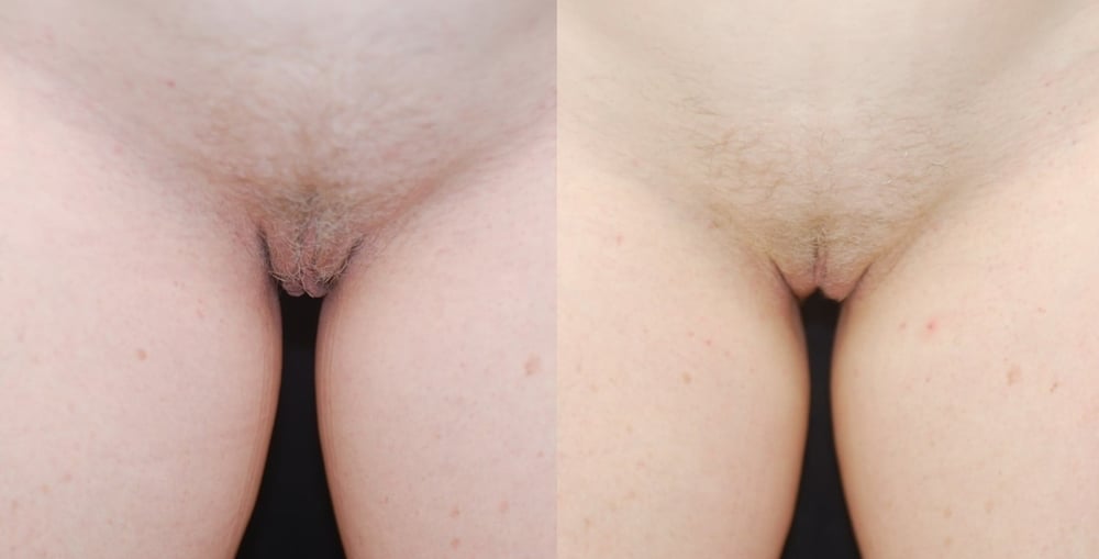 Actual patient of Dr. Devgan, before and 3 months after labiaplasty.