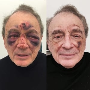 Actual patient of Dr. Devgan, before and 1 week after correction of broken nose (nasal and septal fractures)
