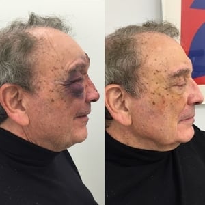 Actual patient of Dr. Devgan, before and 1 week after correction of broken nose (nasal and septal fractures)