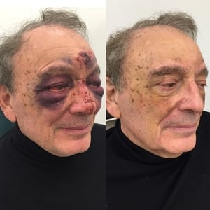 Actual patient of Dr. Devgan, before and 1 week after correction of broken nose (nasal and septal fractures)