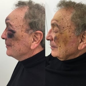 Actual patient of Dr. Devgan, before and 1 week after correction of broken nose (nasal and septal fractures)