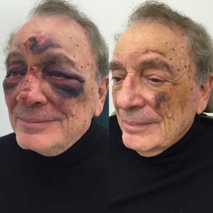 Actual patient of Dr. Devgan, before and 1 week after correction of broken nose (nasal and septal fractures)