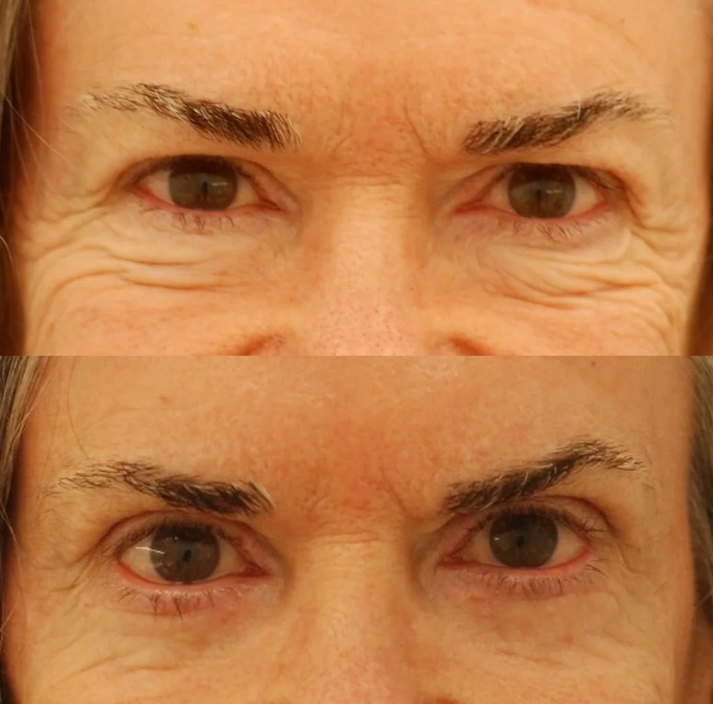 Actual patient of mine, before and just 2 weeks after upper and lower eyelid blepharoplasty. Close-up view