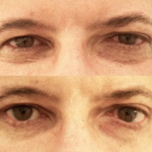 Actual patient of Dr. Devgan, before and after eyelift surgery