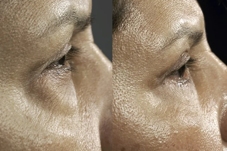 Actual patient of Dr. Devgan, before and after eyelift surgery