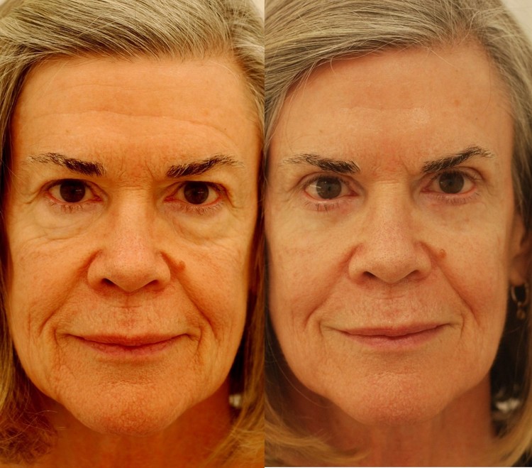 Actual patient of Dr. Devgan, before and after eyelift surgery