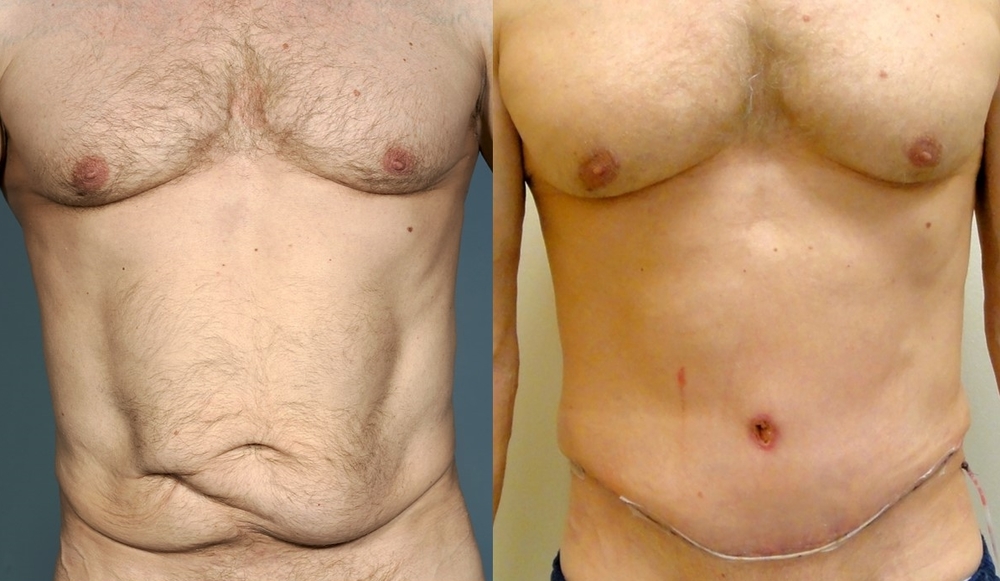 Male Abdominoplasty (Tummy Tuck) Surgery — Lara Devgan, MD, MPH, FACS